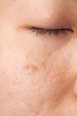 photo: les causes de l'acné